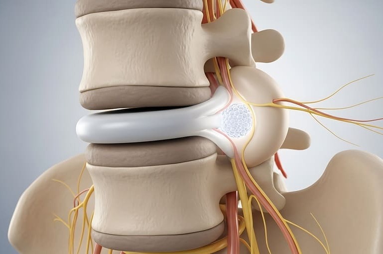 Rückenschmerzen und Bandscheibe: Warum Trainingstherapie ohne Faszienfokus oft scheitert